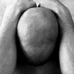 alopecia