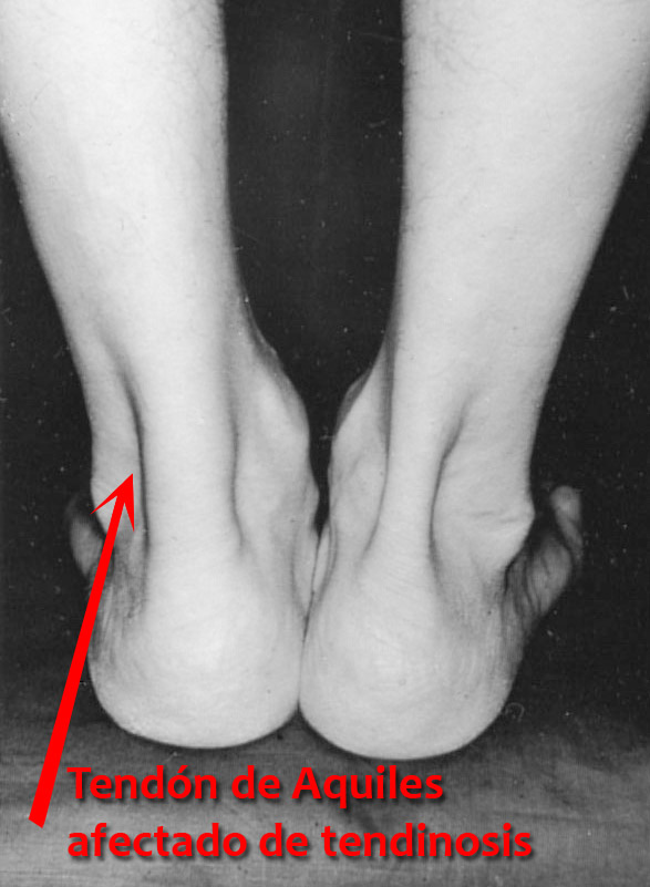 tendinosis